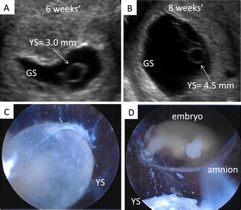can an enlarged yolk sac correct itself|Can Ultrasound Analysis of the Yolk Sac be a Predictor of .